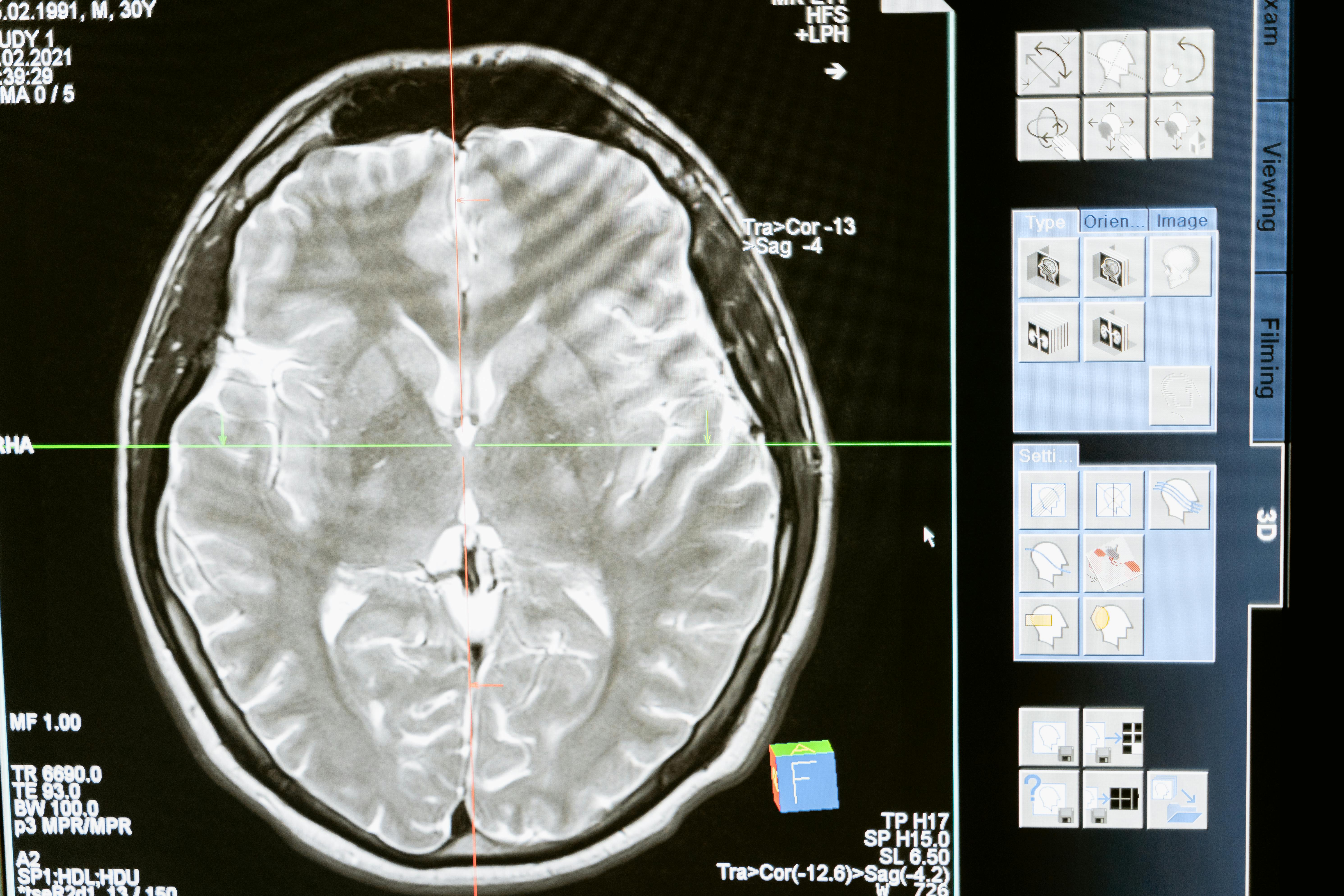 An MRI of a brain